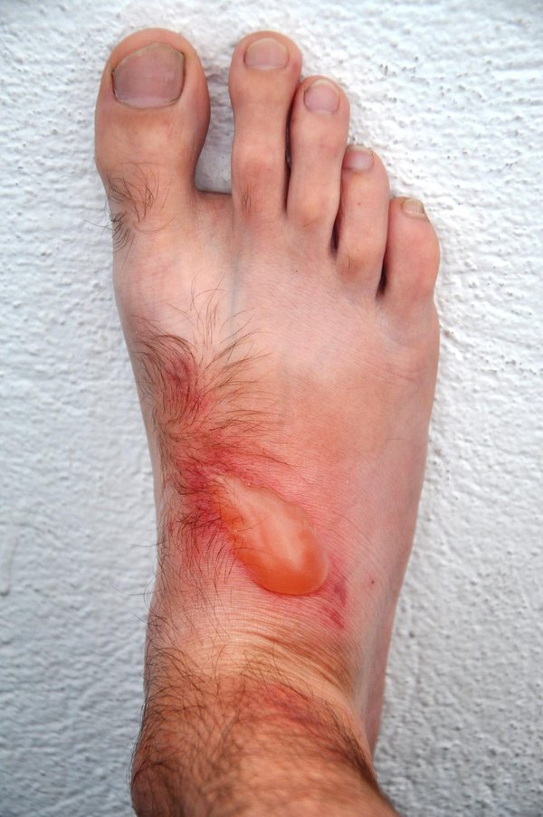 Quelles sont les avancées dans le traitement de la dermatite atopique sévère chez l'adulte ?